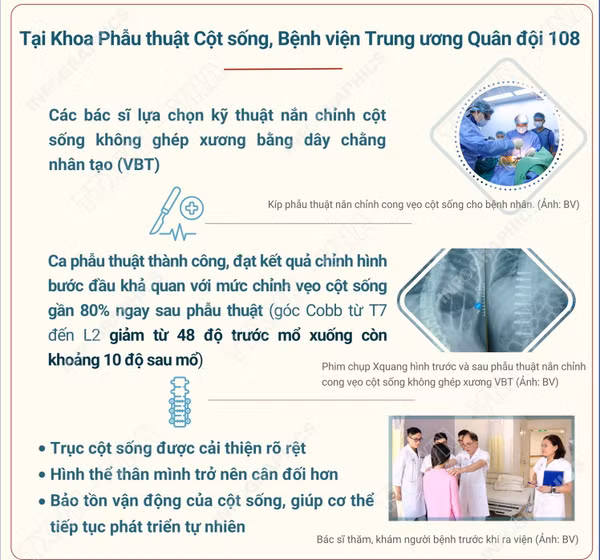 Việt Nam lần đầu phẫu thuật thành công nắn chỉnh vẹo cột sống không ghép xương