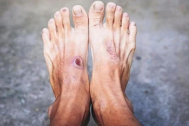 Vết loét do tiểu đường. (Ảnh minh họa)