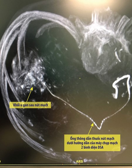 Trị ung thư gan nhờ “khóa” mạch máu nuôi khối u ác tính ảnh 3