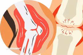 Ung thư xương ác tính là một dạng ung thư xương hiếm gặp. (Nguồn: Vietnam+)