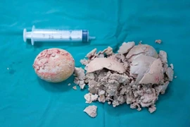 Viên sỏi khổng lồ được lấy ra từ cơ thể bệnh nhân. (Nguồn: Báo Lao động)