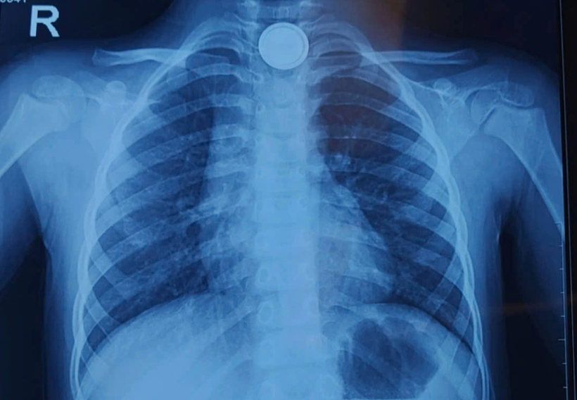 Phim chụp X-quang hình ảnh vị trí pin cúc áo trong cổ bệnh nhi. (Ảnh: BVCC)