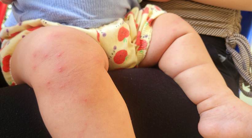 Một bệnh nhi mắc bệnh tay chân miệng với nhiều nốt ban. (Ảnh: TTXVN)