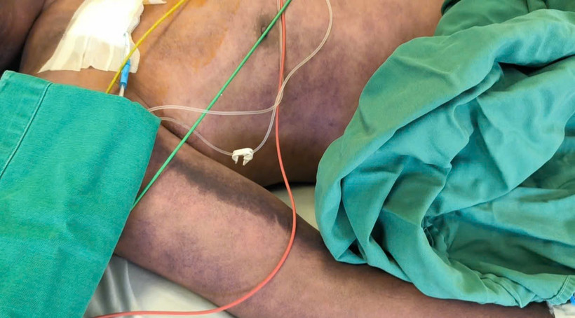 Bệnh nhân nhập viện trong tình trạng ban xuất huyết hoại tử vùng mặt lan nhanh toàn thân. (Ảnh: PV/Vietnam+)