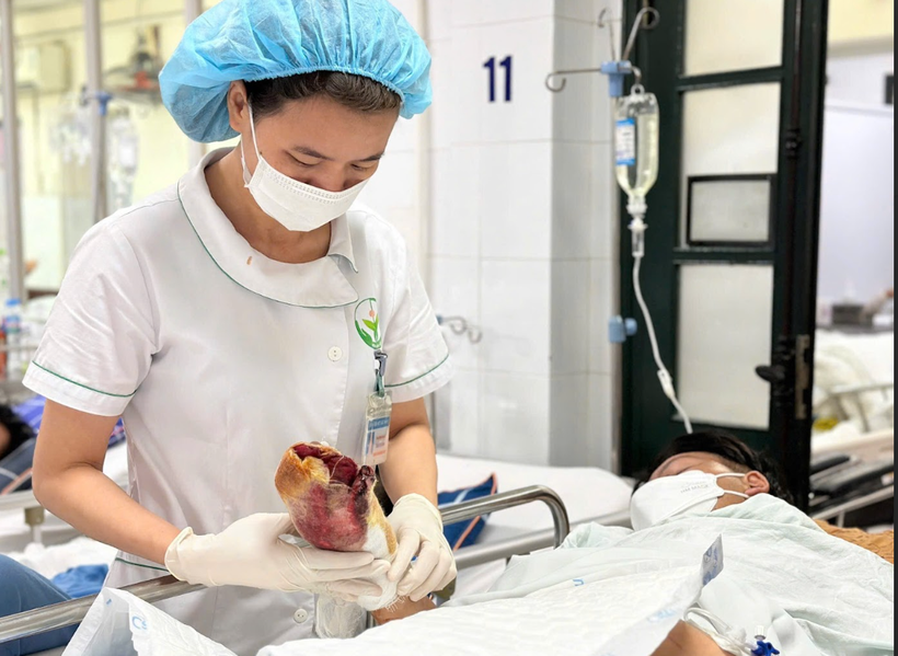 Nam thiếu niên 16 tuổi ở Hà Nam bị cụt tay do pháo nổ tự chế. (Ảnh: PV/Vietnam+)