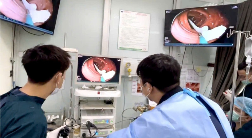 Các bác sỹ nội soi gắp con sán trong đại tràng của bệnh nhân. (Ảnh: PV/Vietnam+)
