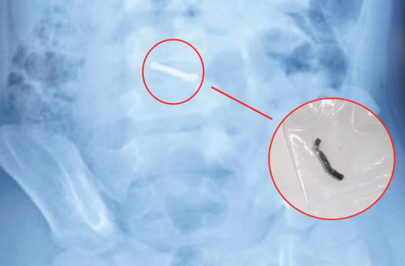 Hình ảnh dị vật qua chụp X-quang và viên nam châm sau khi được các bác sỹ phẫu thuật lấy ra. (Ảnh: PV/Vietnam+)