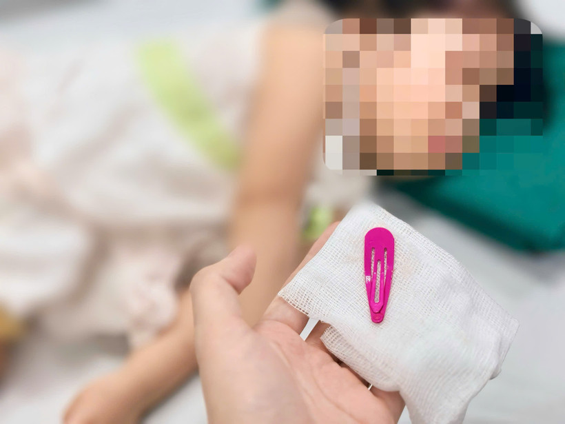 Các bác sỹ lấy ra dị vật là chiếc kẹp tóc bệnh nhân đã nuốt. (Ảnh: PV/Vietnam+)