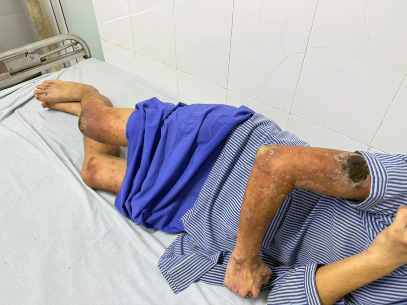 Bệnh nhân với những tổn thương toàn thân. (Ảnh: PV/Vietnam+)