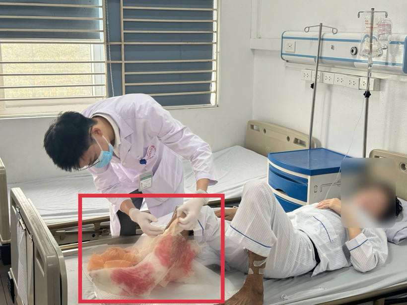 Bệnh nhân nhập viện trong tình trạng cẳng chân hoại tử nặng, bốc mùi hôi thối. (Ảnh: PV/Vietnam+)
