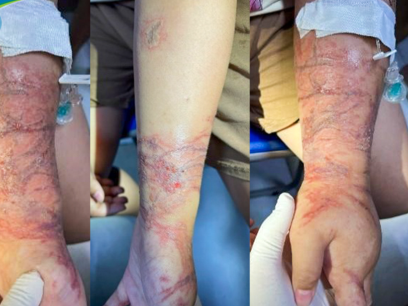 Tổn thương trên cánh tay của bệnh nhi trước khi điều trị. (Ảnh: PV/Vietnam+)