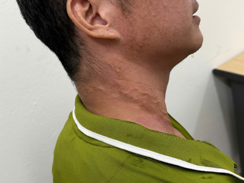 Người bệnh với những dấu vết do giun rồng gây ra. (Ảnh: PV/Vietnam+)