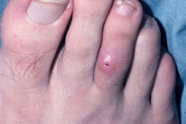 Vết thương do bệnh Myiasis. (Ảnh: medscape)