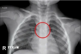 Hình ảnh chiếc kim chọc tuỷ rơi vào trong đường thở của bé trai 3 tuổi. (Ảnh: TTXVN phát)