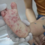 Các nốt phát ban của bệnh nhi bị tay chân miệng. (Ảnh: TTXVN/Vietnam+)