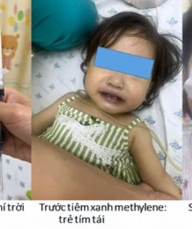 Bé gái tím tái, nguy kịch sau khoảng 1 giờ ăn ghẹ và canh cải bó xôi nấu với nước giếng. (Nguồn: Bệnh viện Nhi đồng Thành phố)