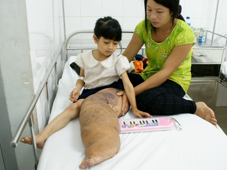Phẫu thuật thành công cho cô bé có “chân voi” 15 kg ảnh 1