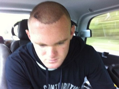 Rooney lộ đầu đầy sẹo sau khi đi chữa bệnh hói ảnh 1