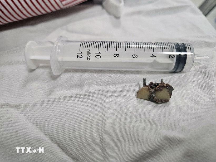 Dị vật là 2 chiếc răng giả được nội soi lấy ra khỏi phế quản bệnh nhân. (Ảnh: TTXVN phát)