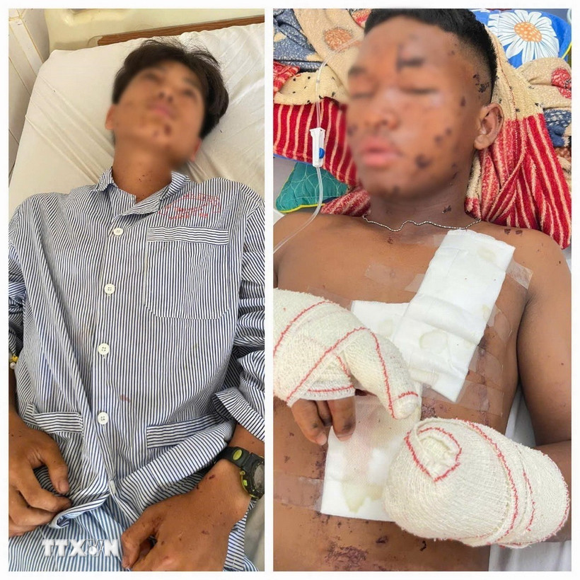 Hai nạn nhân được điều trị tại Khoa Ngoại tổng hợp, Bệnh viện Đa khoa tỉnh Gia Lai. (Ảnh: Hồng Điệp/TTXVN)