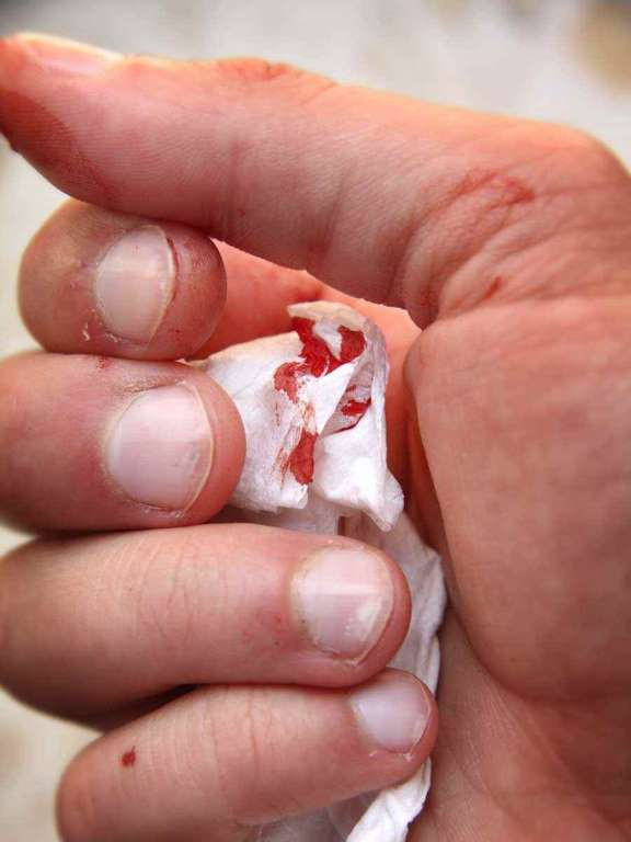 Chảy máu không rõ nguyên nhân. (Nguồn: Getty Images)