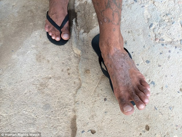 Mặc dù có nhiệm vụ duy trì trật tự bên trong nhà tù nhưng các đại ca lại làm ngơ với các vụ đánh nhau, cưỡng hiếp và bệnh tật. Trong ảnh là một người tù bị bệnh phát ban 3 năm nhưng không được điều trị. (Nguồn: Dailymail)