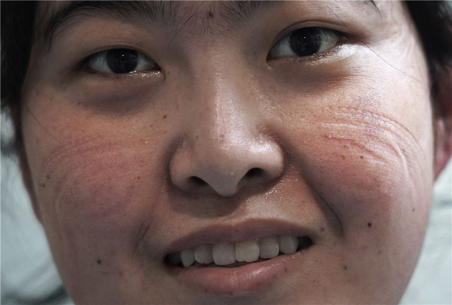 Tại các khu cách ly và ICU, nhân viên y tế mặc đồ bảo hộ, khẩu trang phẫu thuật, kính bảo hộ và găng tay dùng một lần. Sau một ca làm việc, mặt nạ và kính bảo hộ để lại những dấu hằn trên khuôn mặt họ. (Nguồn: Xinhua)