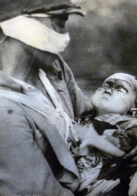 Mặc dù đang cuốn gạc cầm máu nhưng bà mẹ này vẫn ôm và cho con bú. (Nguồn: Dailymail)