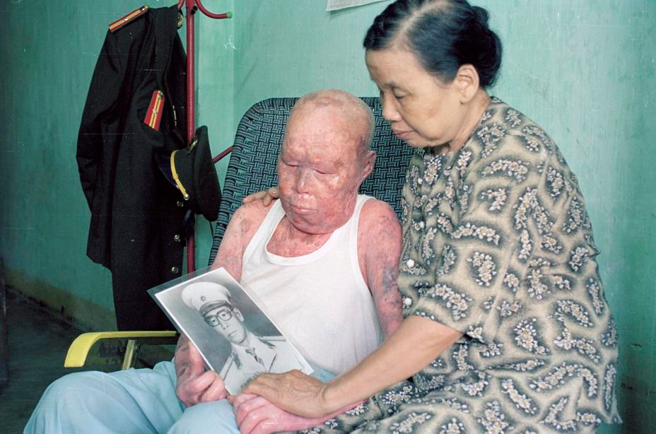 Bác Từ Đức Phảng, ở phường Phước Long, thành phố Nha Trang, tỉnh Khánh Hòa, trong chiến tranh là chiến sỹ quân cảnh bảo vệ đường, kho, trạm. Năm 1975, bác Phản trực tiếp cứu chữa vụ cháy kho vũ khí Đồng Bà Thìn - Cam Ranh và bị nhiễm chất độc da cam/dioxin, khiến da bị nổi từng mảng đen, đỏ, tóc, lông mày, lông mi rụng hết. (Ảnh: Ngô Mỹ/TTXVN)