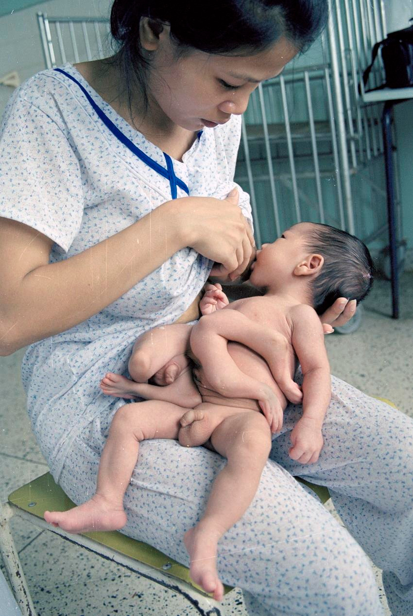 Cháu Lê Tiến Dũng, con anh Lê Hồng Tuyến, ở huyện Cam Lộ, tỉnh Quảng trị. Anh Tuyến từng tham gia chiến trường Quảng Trị thời kỳ chống Mỹ, bị ảnh hưởng chất độc da cam nên khi cháu Dũng sinh ra bị dị dạng do ảnh hưởng chất độc da cam/dioxin. (Ảnh: Thu Hoài/TTXVN)