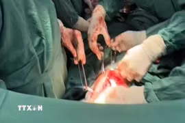 Các y, bác sỹ Bệnh viện đa khoa Bạc Liêu phẫu thuật khâu vết thương tâm thất trái, xử lý nhu mô phổi bị thủng và dẫn lưu màng phổi nhằm giữ lại sự sống cho bệnh nhân L.T.Đ. (Ảnh: TTXVN phát)