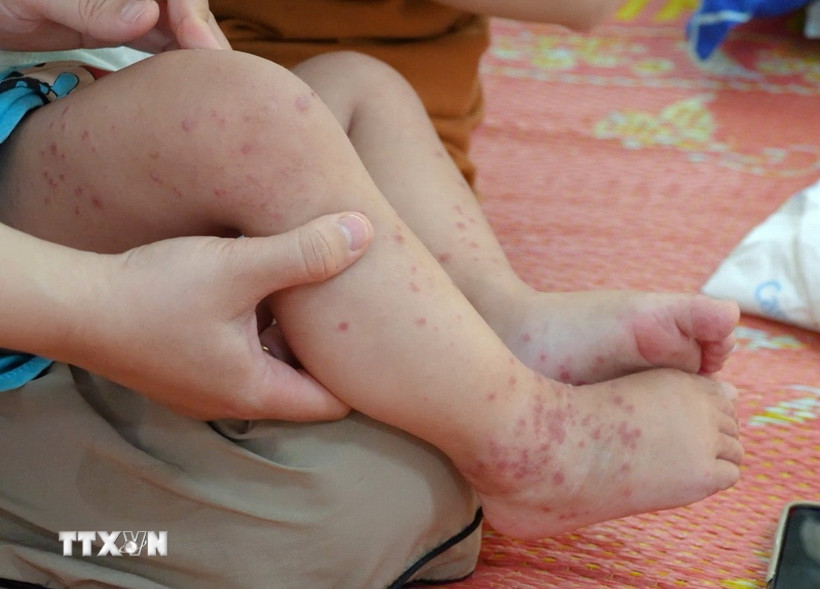 Các nốt bọng trên chân trẻ mắc tay chân miệng. (Ảnh: TTXVN phát)