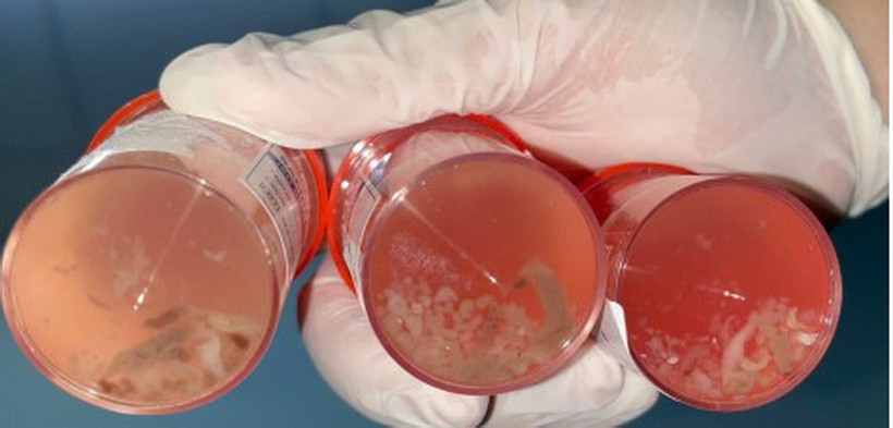 "Dị vật” màu trắng xám (giun lươn) từ dịch rửa phế quản phổi người bệnh. (Nguồn: Bệnh viện Nhân dân 115 Thành phố Hồ Chí Minh)