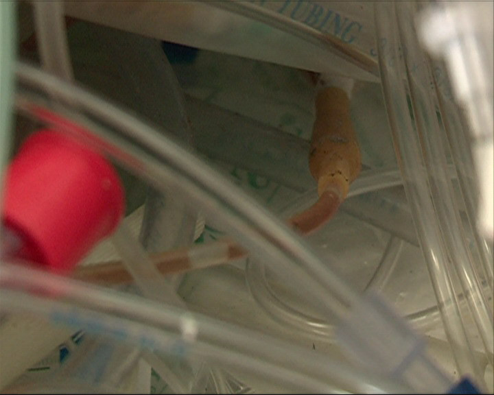 Dây dịch truyền đã ngả màu vì vẫn còn dính vết máu, hóa chất? (Ảnh: Thùy Giang/Vietnam+)