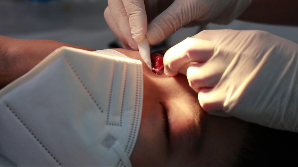 Giả mạc bít vào mặt sau mắt làm cho thuốc tra không ngấm vào được. (Ảnh: T.G/Vietnam+)