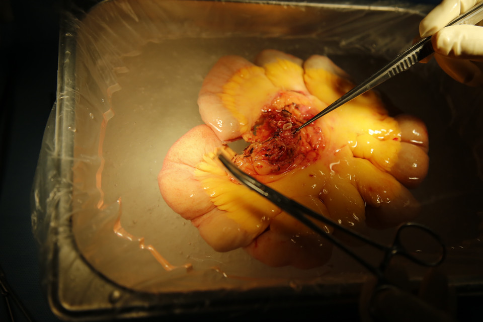 Phần ruột ghép được người thân của bệnh nhân hiến. (Ảnh: PV/Vietnam+)