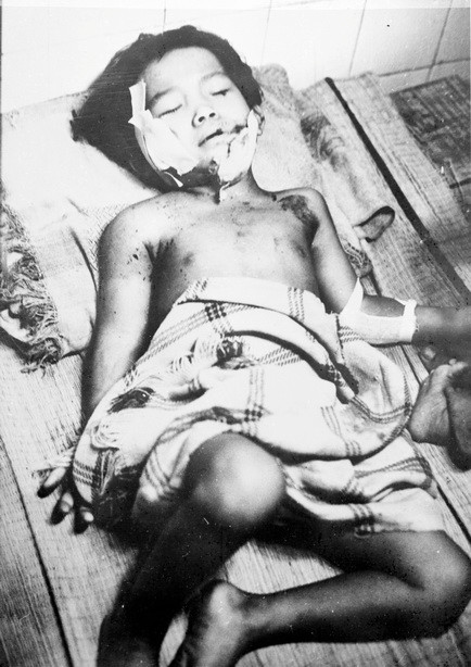 Một em bé còn sống sót, trên người mang đầy những vết dao của quân Pol Pot tàn sát đêm 30/4/1977. (Nguồn: TTXVN)