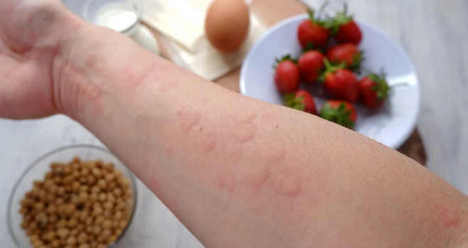 Fotografie ilustrativă. (Sursa: Food Allergies Atlanta) di-ung.png