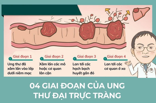Ung thư đại trực tràng - người trẻ đừng chủ quan kẻo sớm ân hận ung-thu-dai-truc-trang.jpg