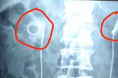 Kết quả chụp CT cho thấy sỏi đã bám quanh ống thông JJ, lấp đầy gần hết đài bể thận hai bên. (Ảnh do bệnh viện cung cấp)