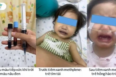 Bé gái tím tái, nguy kịch sau khoảng 1 giờ ăn ghẹ và canh cải bó xôi nấu với nước giếng. (Nguồn: Bệnh viện Nhi đồng Thành phố)