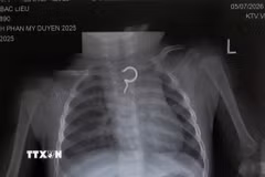 Hình ảnh X-quang phát hiện dị vật cản quang tại thực quản. (Ảnh: TTXVN phát)