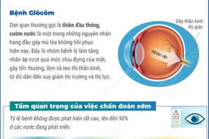 Chủ động khám mắt định kỳ để chẩn đoán sớm bệnh bệnh Glôcôm