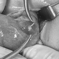 Phẫu thuật cho bé trai bị xương cá đâm thủng ruột. (Ảnh: TTXVN phát)