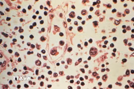 Mẫu bệnh phẩm của một bệnh nhân nhiễm virus Hanta. (Ảnh: Reuters/TTXVN)