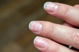Đừng chủ quan với những dấu hiệu bất thường trên móng tay của bạn. (Ảnh: Getty)