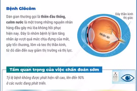 Chủ động khám mắt định kỳ để chẩn đoán sớm bệnh bệnh Glôcôm