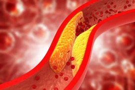 Hình minh họa mỡ cholesterol xấu (LDL-C) lắng đọng thành từng mảng bám trên thành mạch máu, gây hẹp lòng mạch, cản trở lưu thông máu. (Ảnh: iStock)