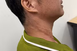 Người bệnh với những dấu vết do giun rồng gây ra. (Ảnh: PV/Vietnam+)