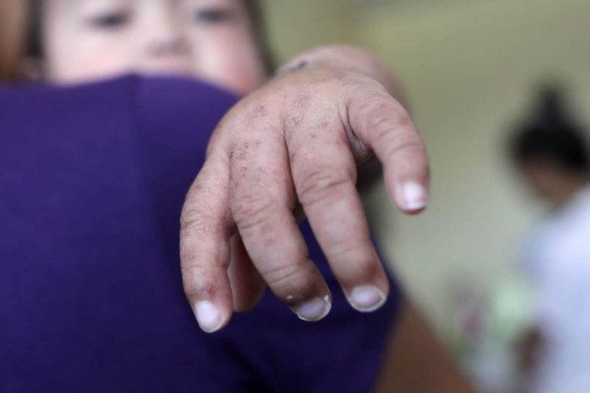 Số ca nhiễm virus sởi ở Mỹ tăng lên gần 1.000 người ảnh 1